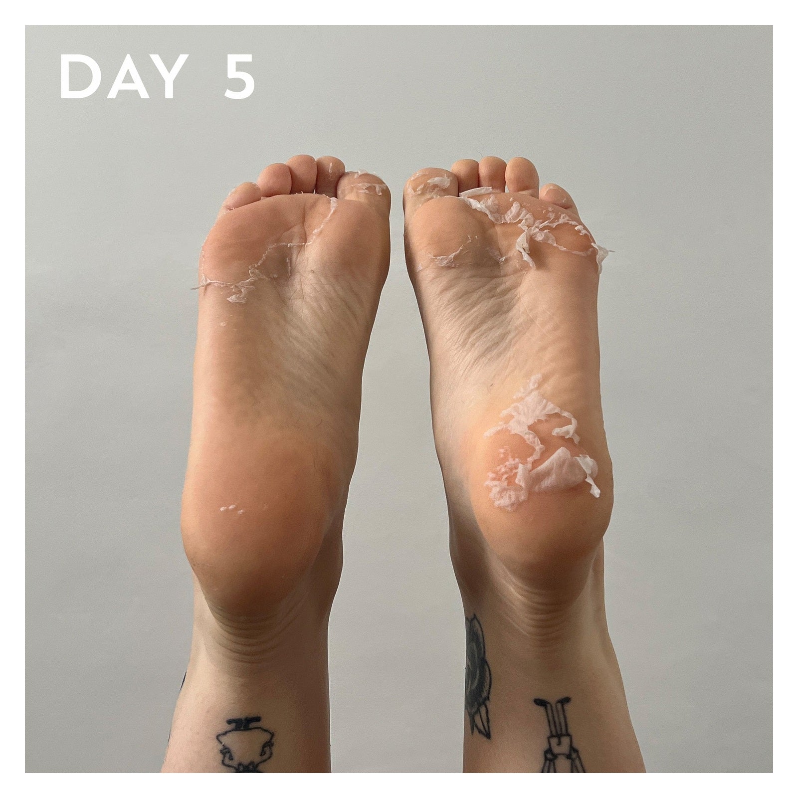 Maskology FOOT PEEL Treatment