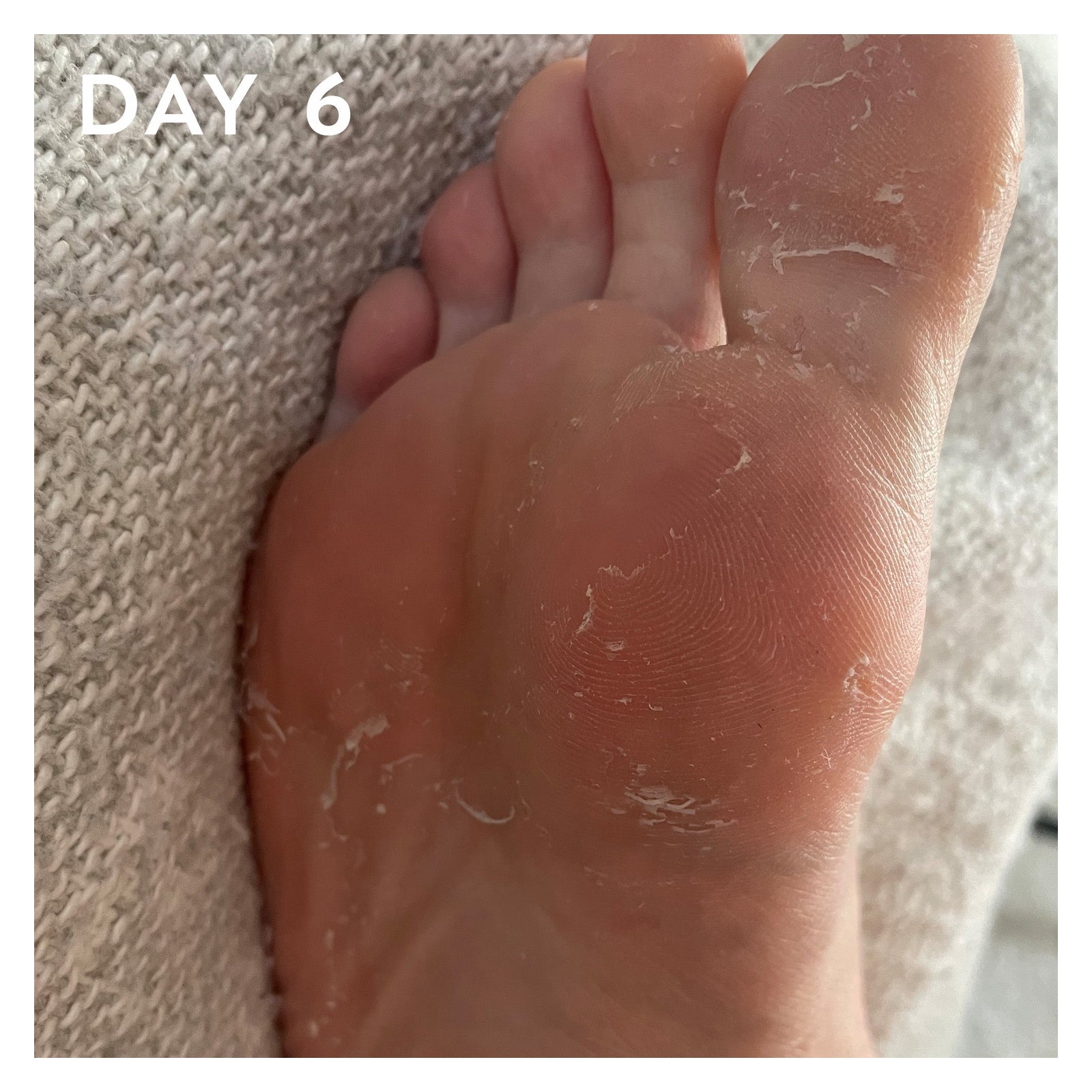 Maskology FOOT PEEL Treatment